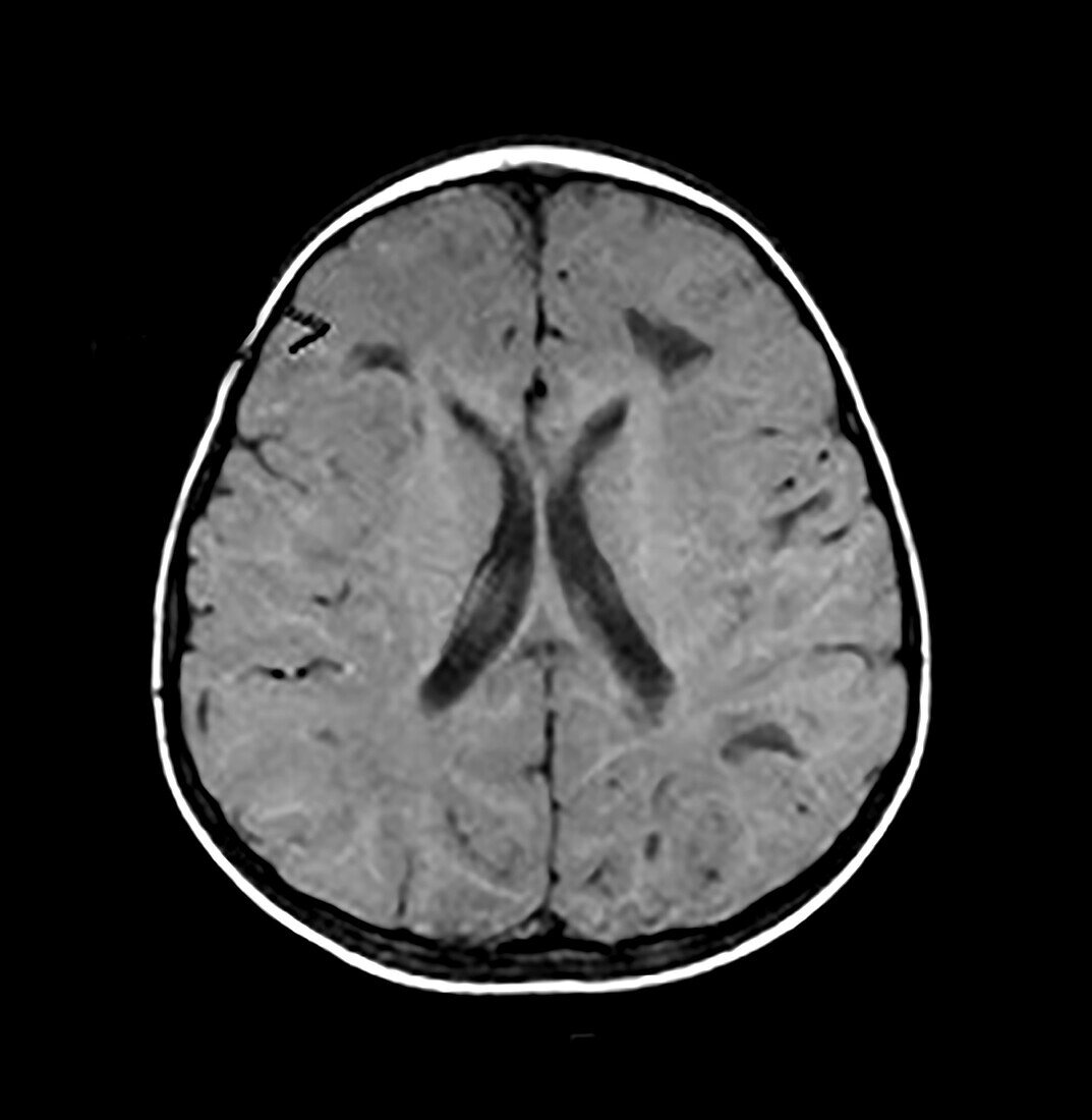 Vanishing White Matter Disease