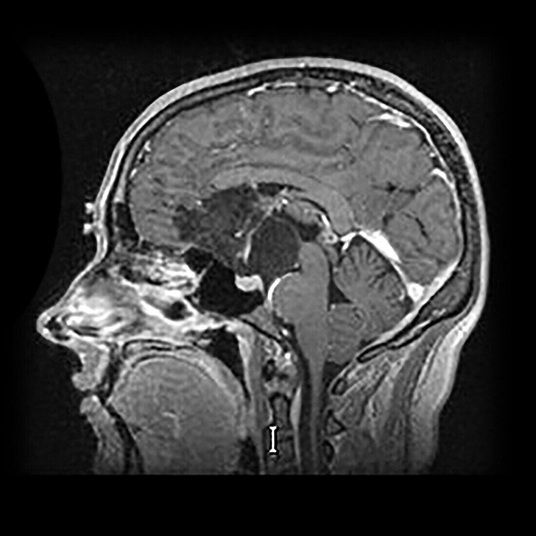 Intracranial Dermoid Cyst on MRI