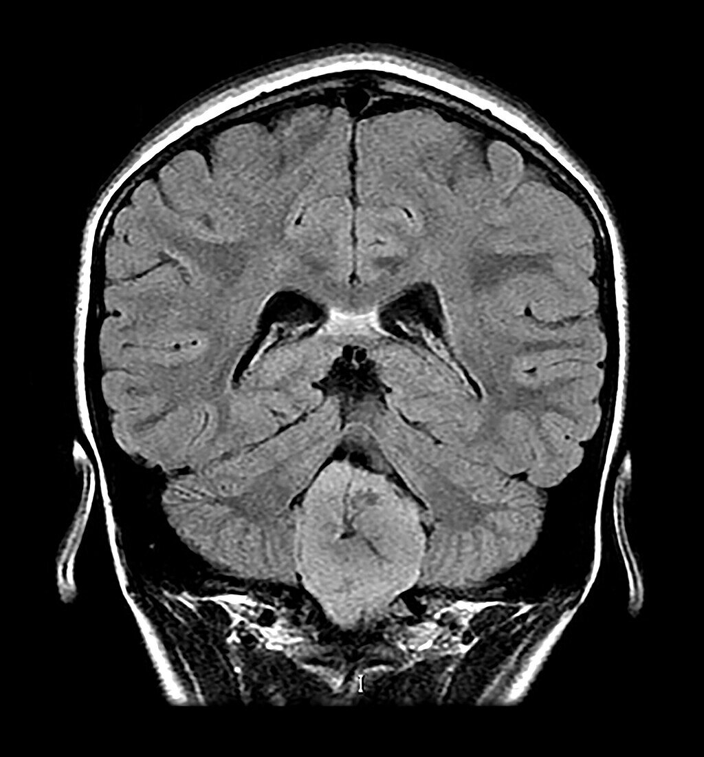 Fourth Ventricular Ependymoma