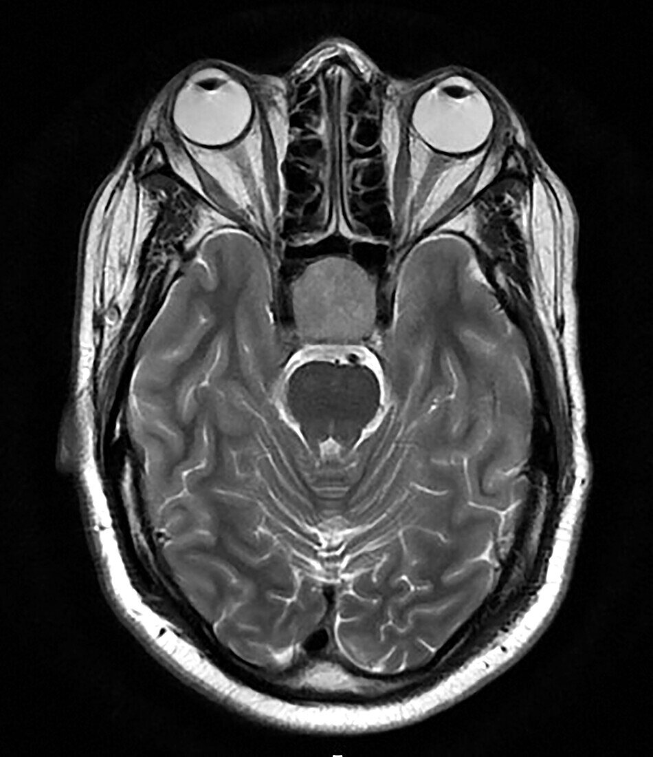 MRI Pituitary Macroadenoma