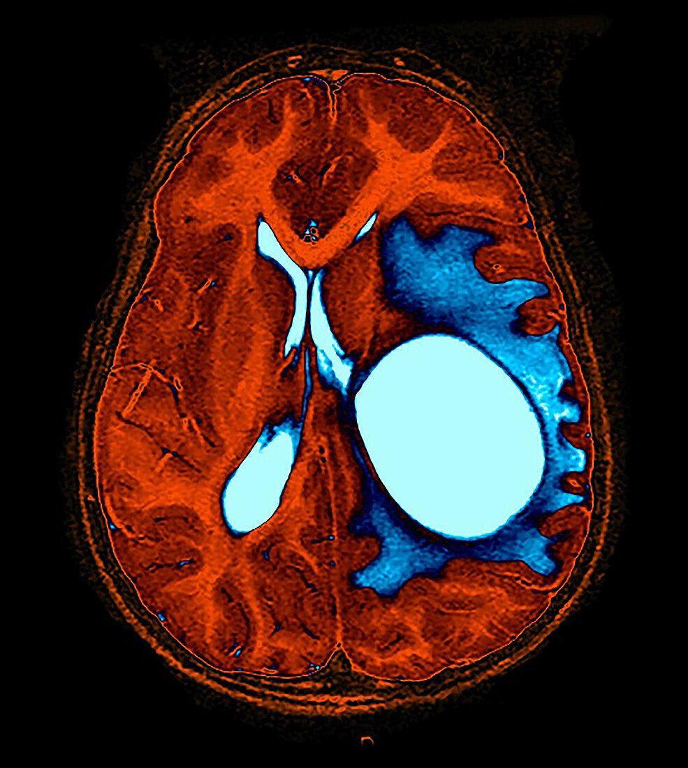 Colour Enhanced Primitive Neuroectodermal Tumour (PNET) MRI