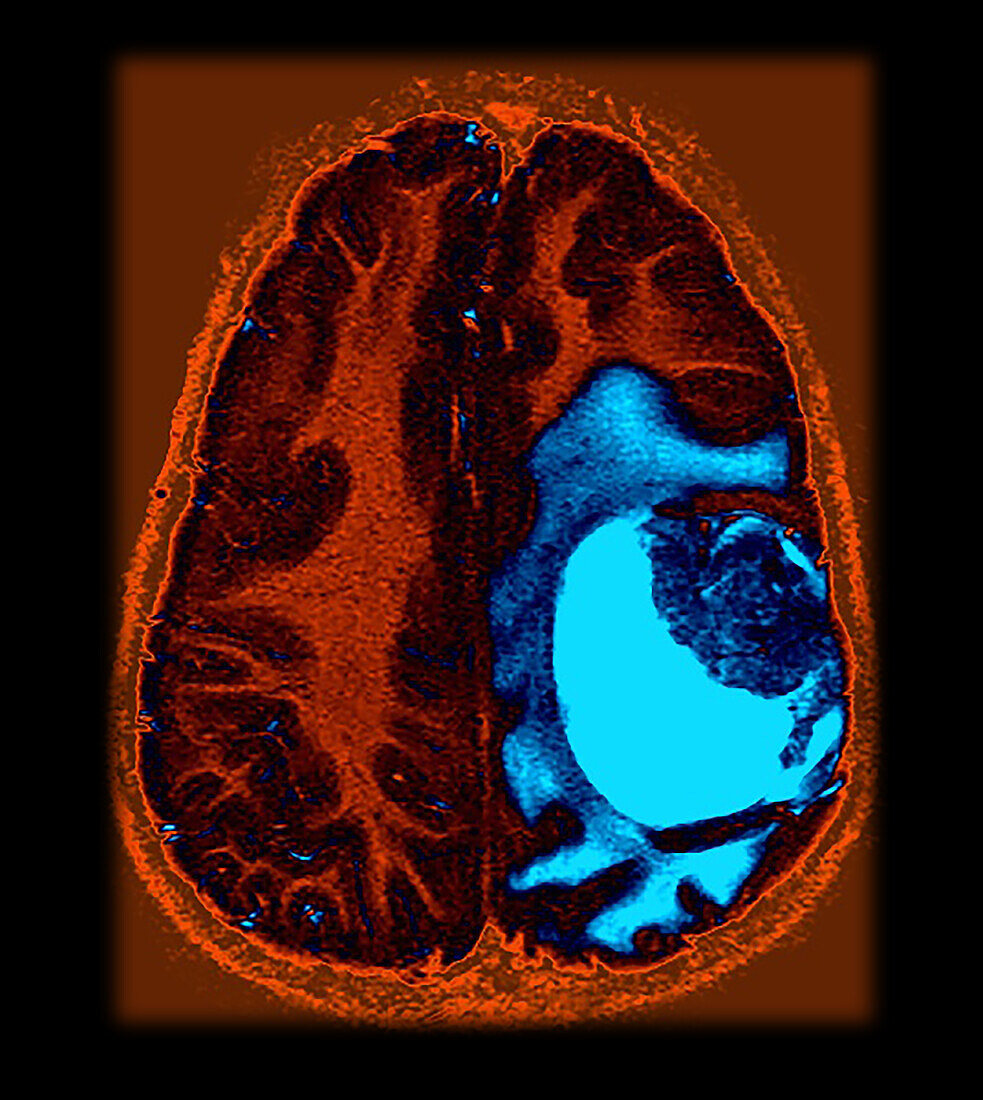 Colour Enhanced Primitive Neuroectodermal Tumour (PNET) MRI