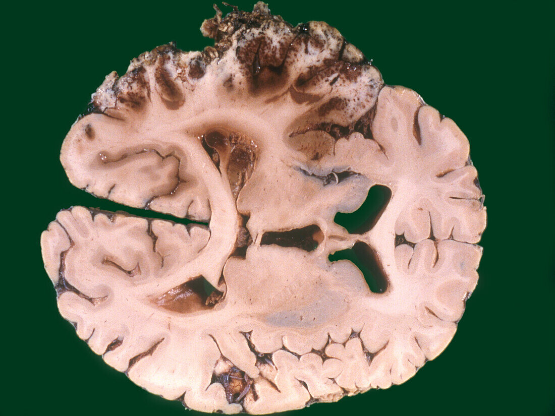 Hemorrhagic Cerebral Infarct