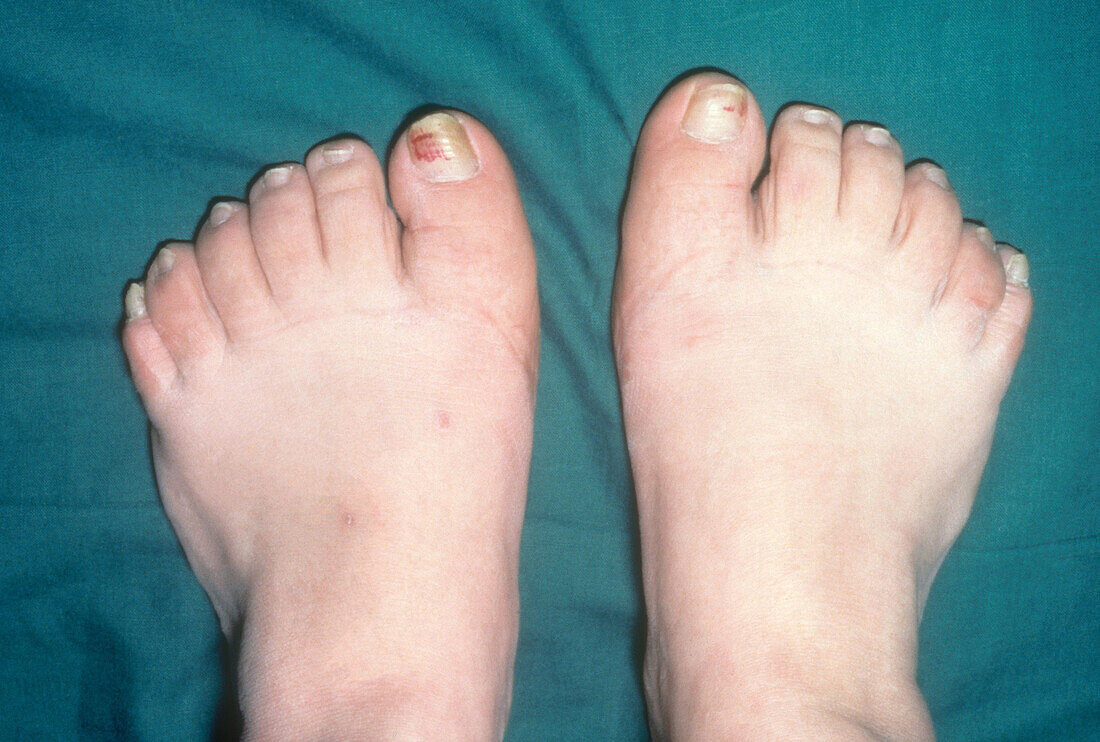 Human feet with 6 toes
