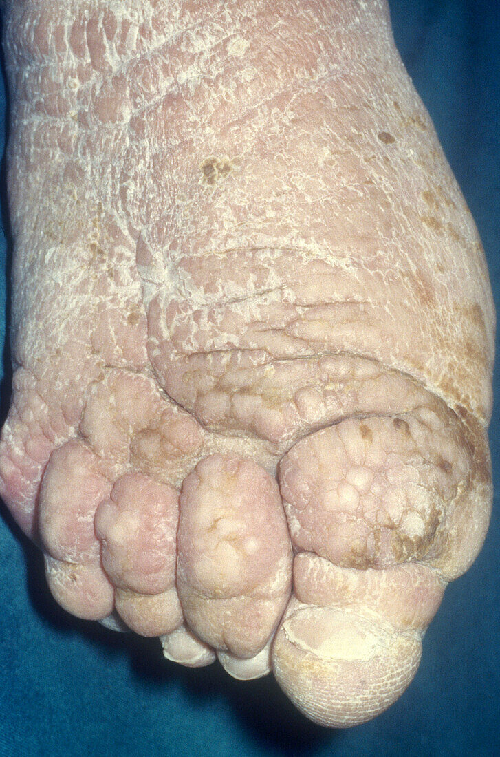 Foot with Myxoedema