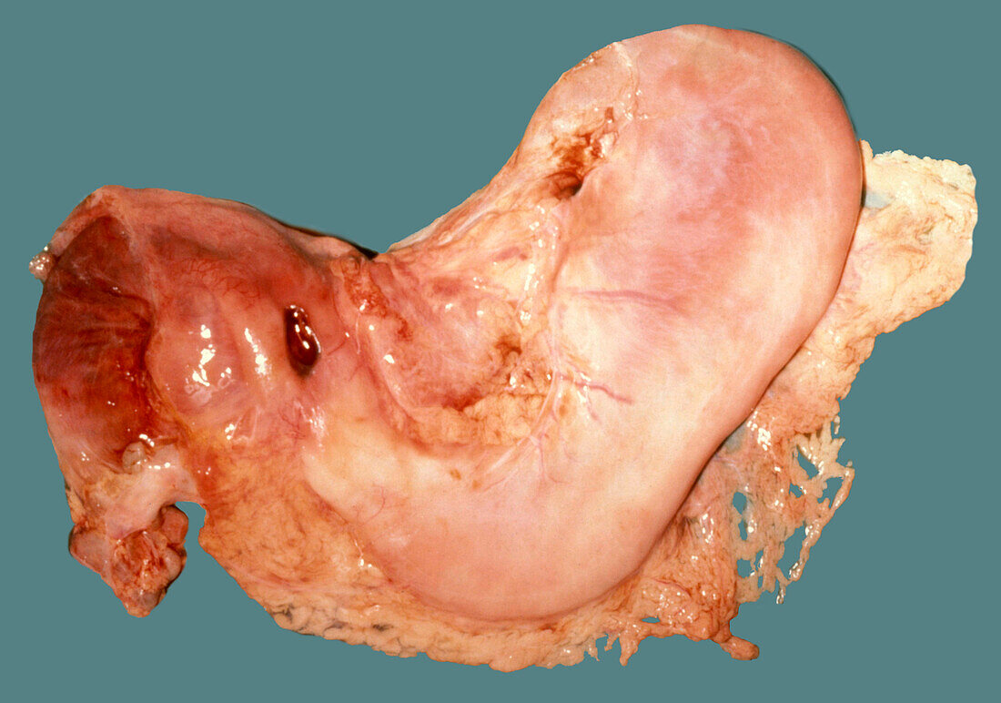 Preforated peptic ulcer, gross specimen