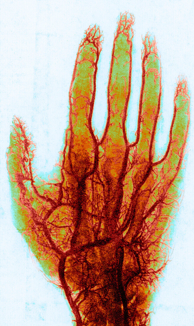 X-ray of blood vessels