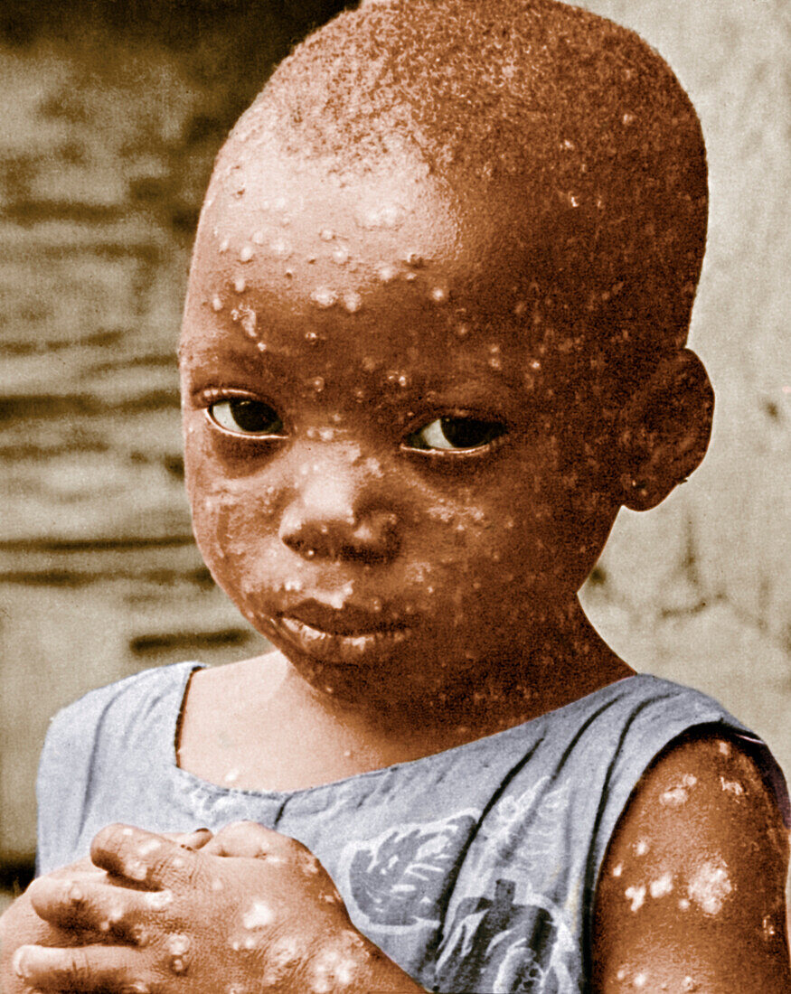 Child with smallpox