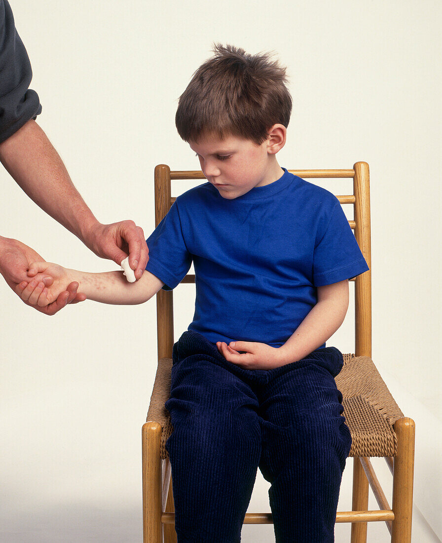 Applying calamine lotion to nettle rash on boy's forearm