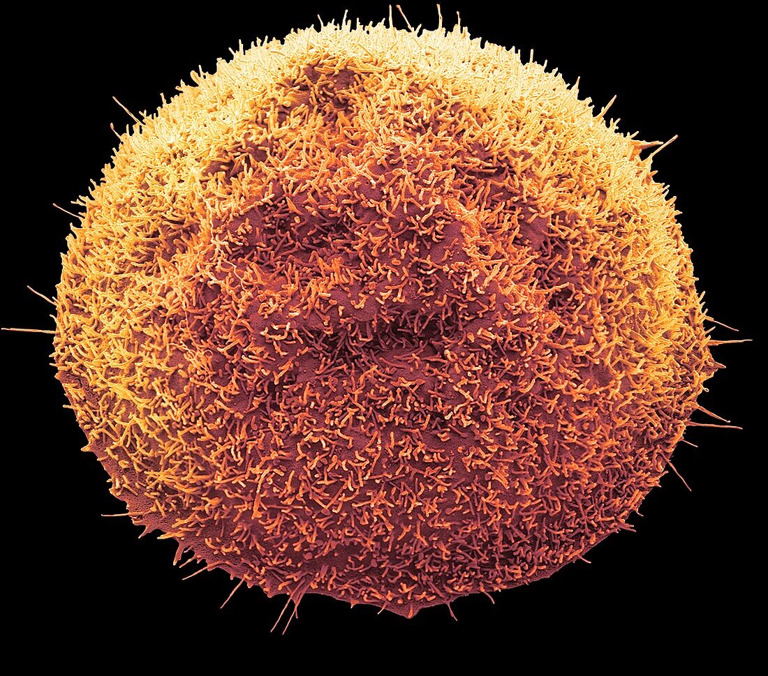 Colorectal cancer cell, SEM