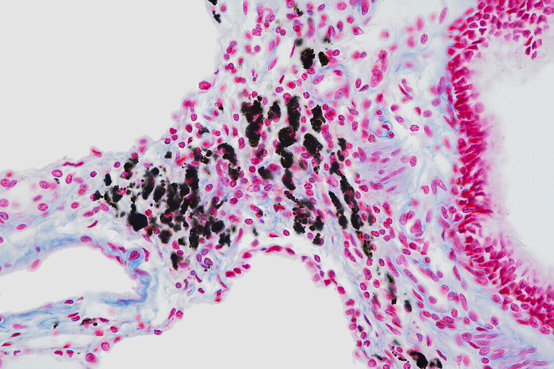 Smoker's lung, light micrograph