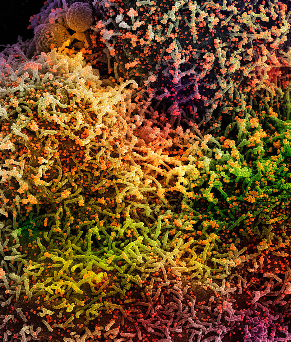 Cell infected by SARS-Cov-2 virus particles, SEM