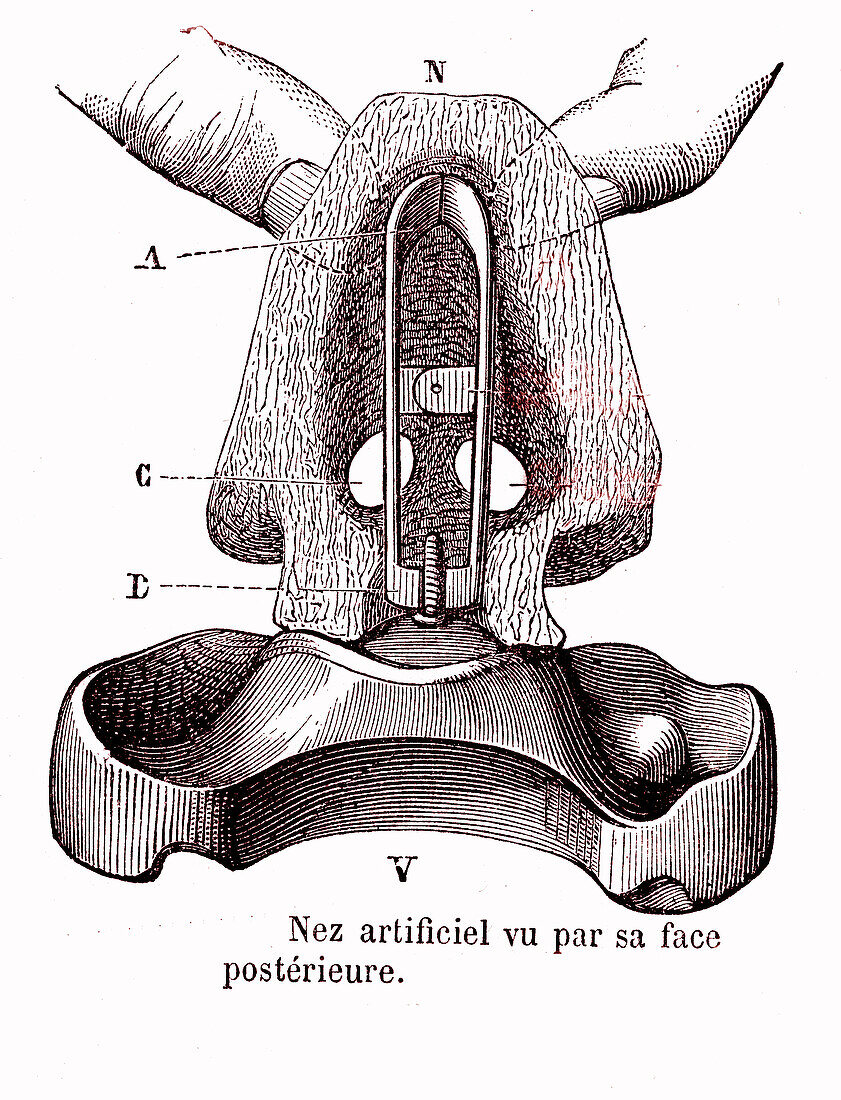 Artificial nose, 19th century illustration