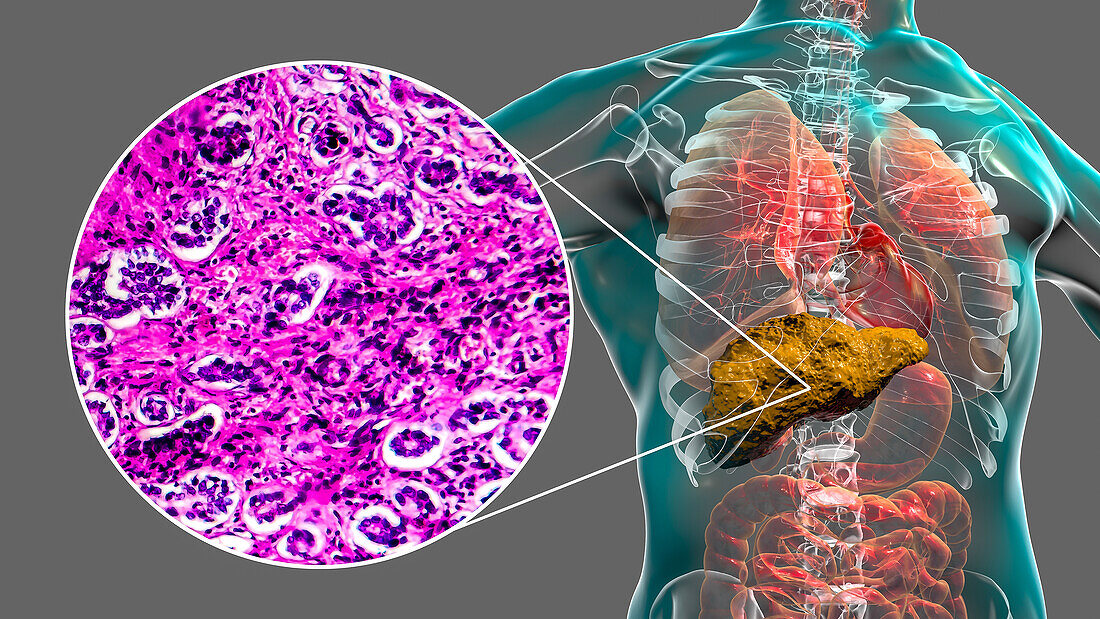 Liver cirrhosis, illustration and light micrograph