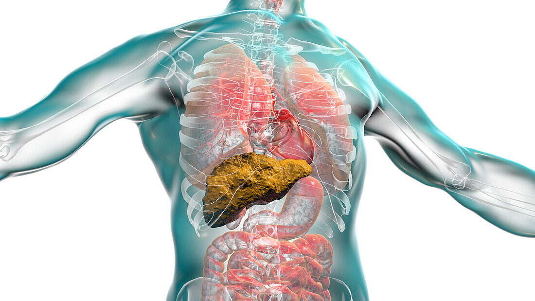 Liver Cirrhosis, illustration