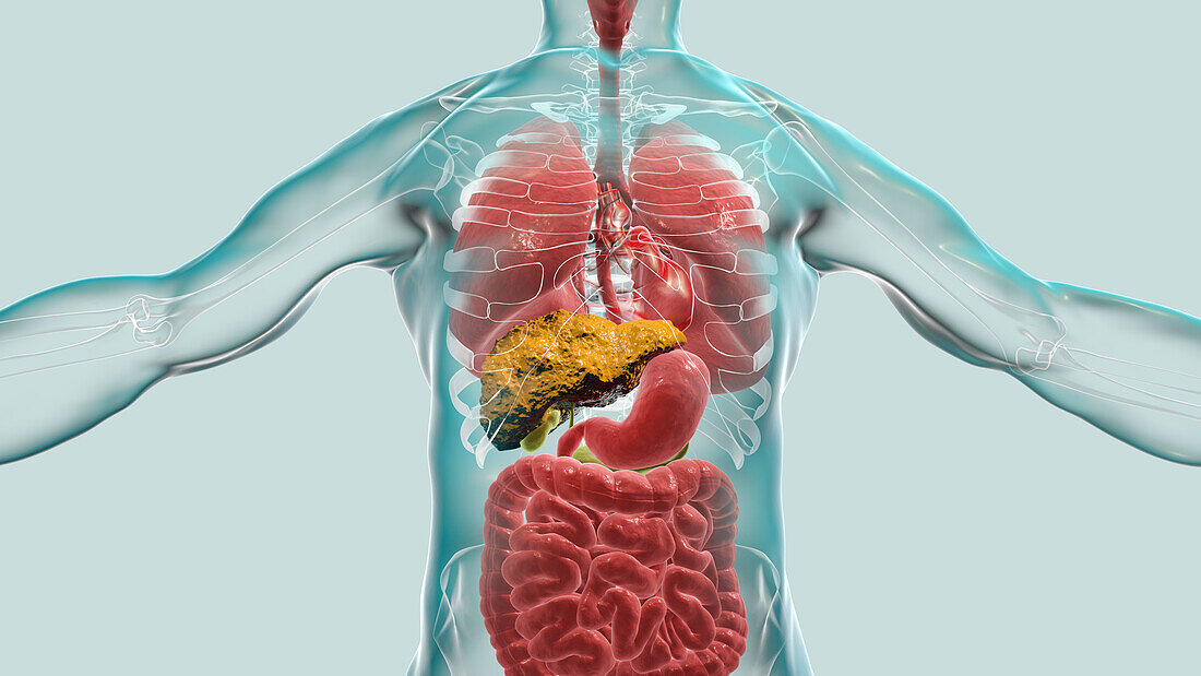 Liver Cirrhosis, illustration