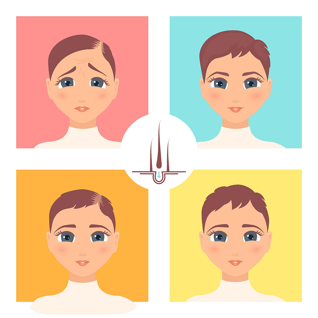 Hair transplantation surgery result in women, illustration