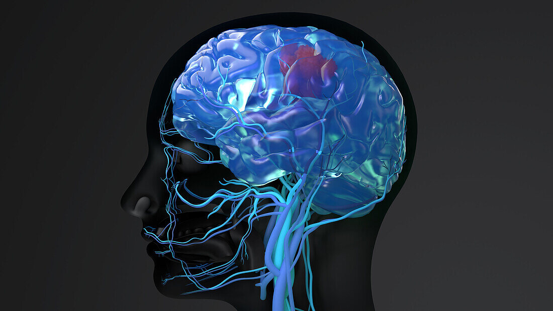 Brain cancer, conceptual illustration