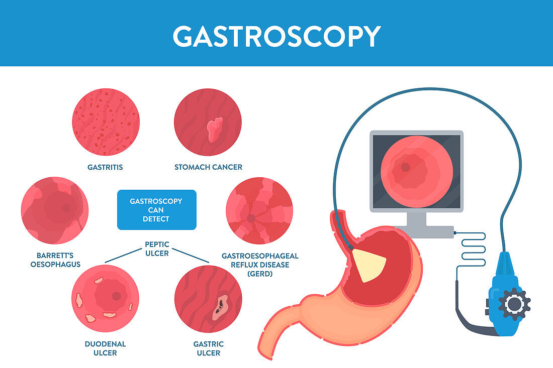 Gastroscopy procedure, illustration