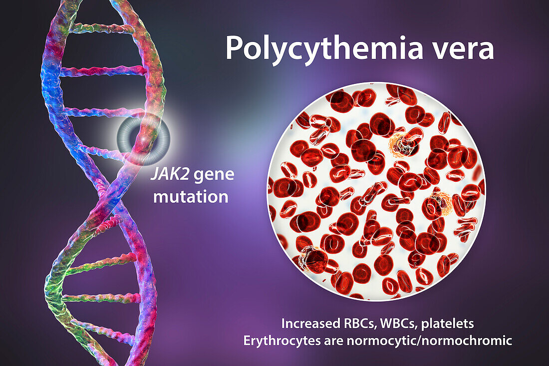 Polycythemia vera, illustration