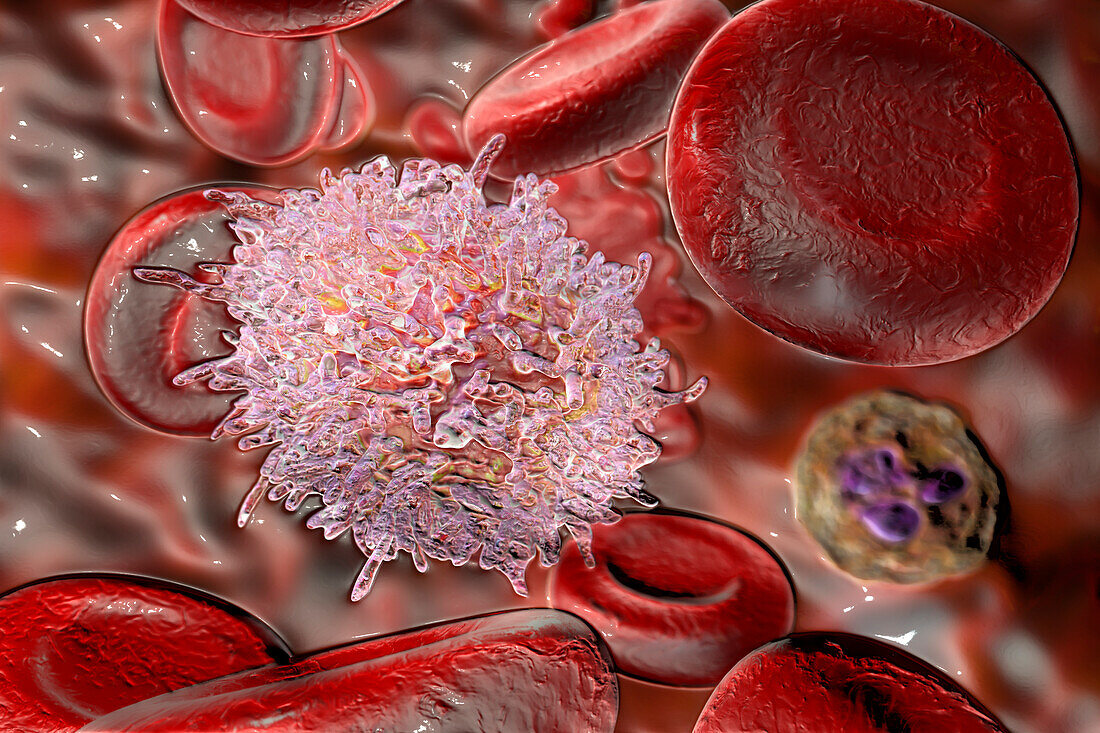 Lymphocyte in hairy cell leukaemia, illustration