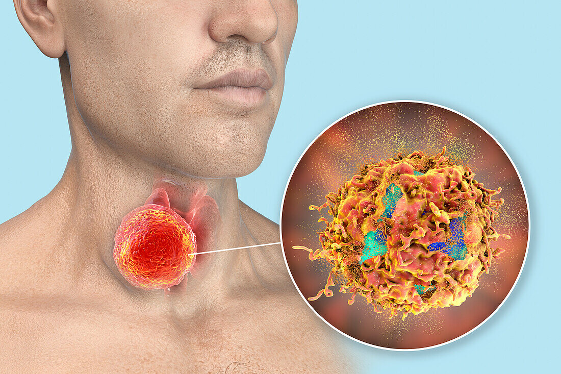 Thyroid gland cancer treatment, conceptual illustration