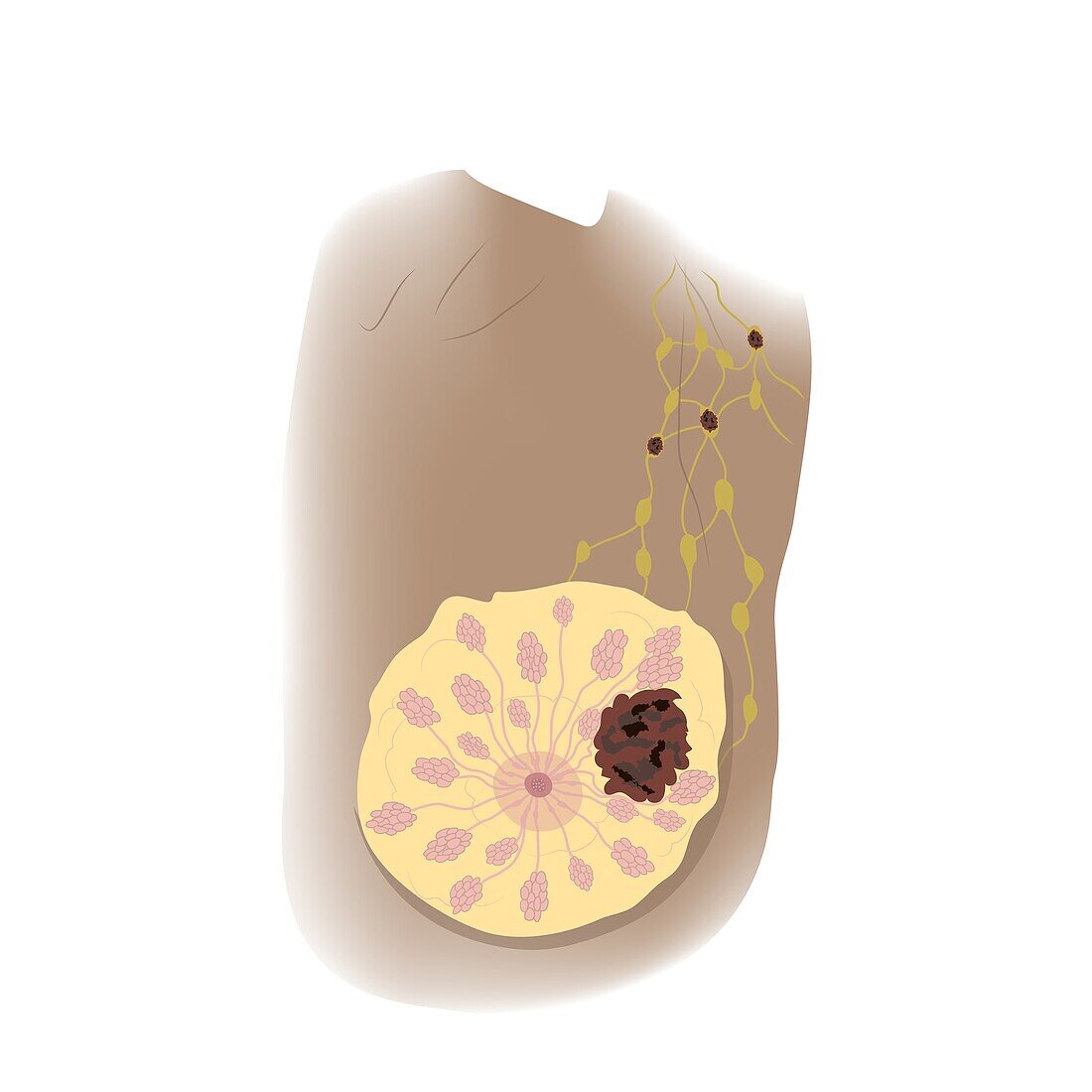 Female breast cancer T3, illustration