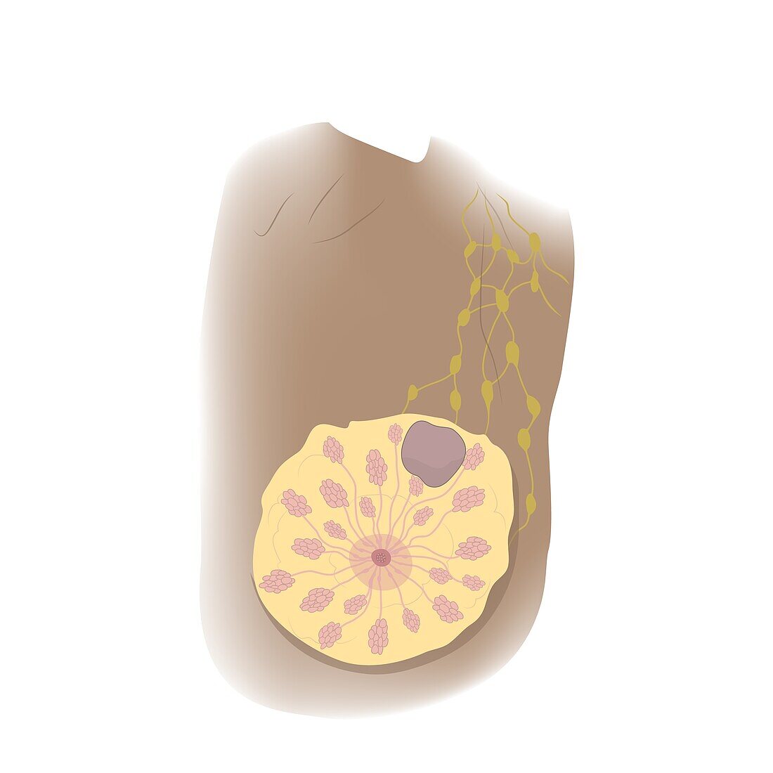Fibroadenoma in female breast, illustration