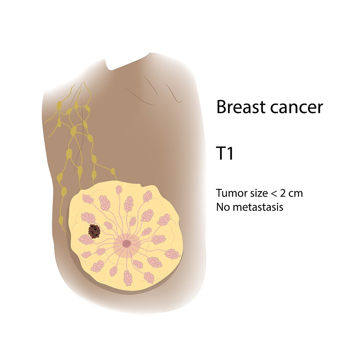 Female breast cancer T1, illustration