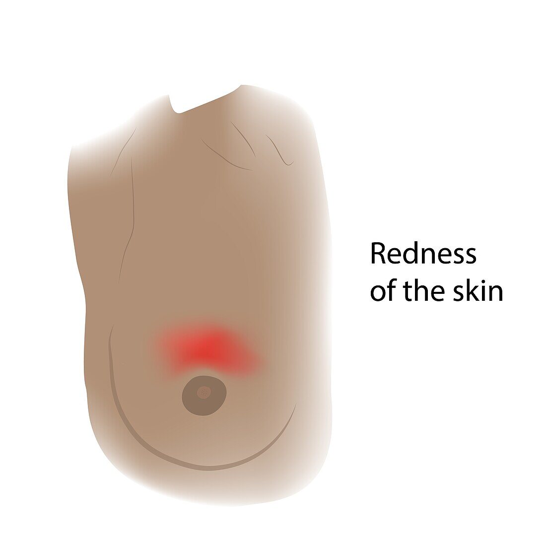 Redness of skin of female breast, illustration