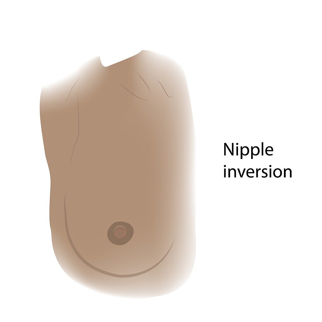 Nipple inversion of female breast, illustration