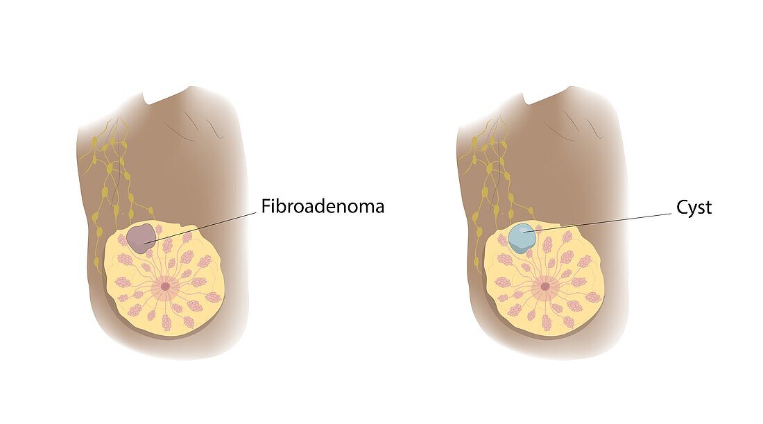 Fibroadenoma and cyst comparison, illustration
