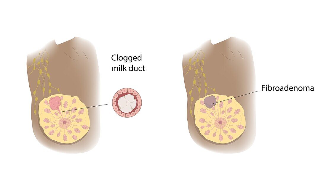 Clogged milk duct and fibroadenoma comparison, illustration
