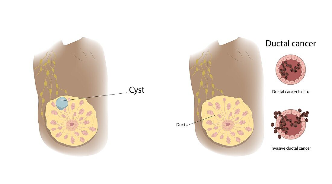 Cyst and ductal cancer comparison, illustration
