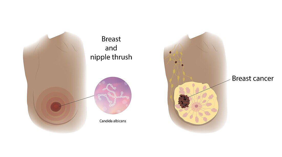 Thrush and breast cancer comparison, illustration