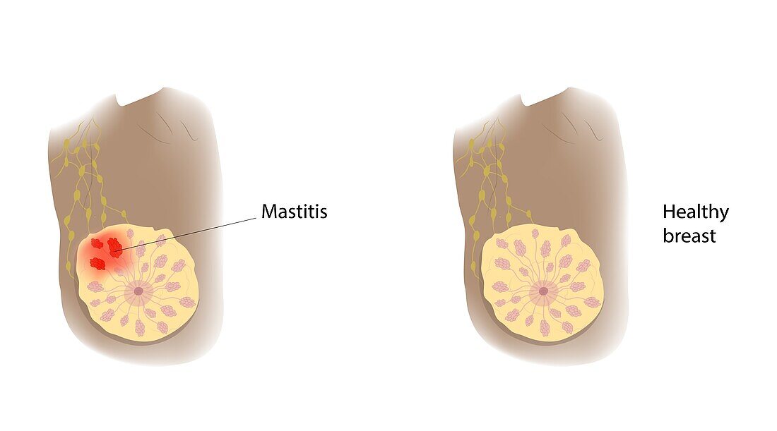 Healthy breast and mastitis, illustration
