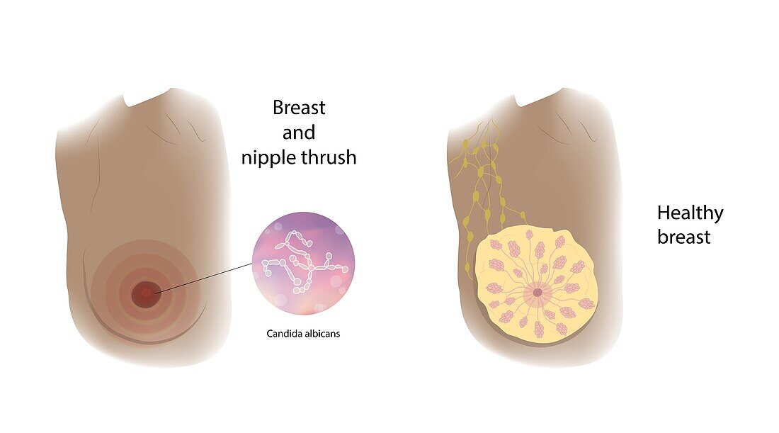 Healthy breast and thrush infection, illustration