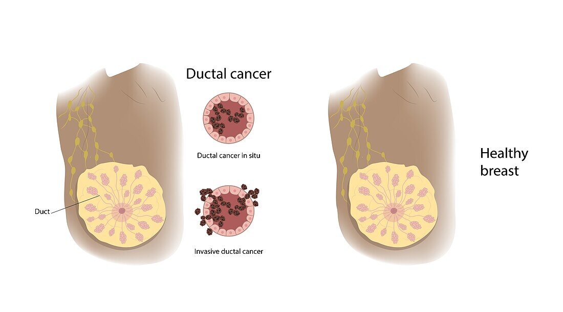 Healthy breast and ductal cancer, illustration