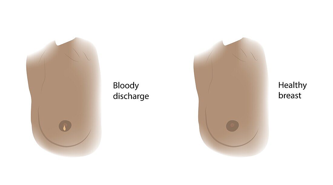 Healthy breast and bloody discharge, illustration