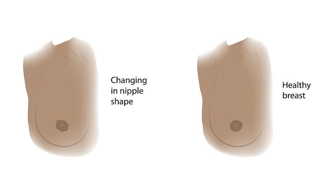 Healthy breast and changes in nipple shape, illustration