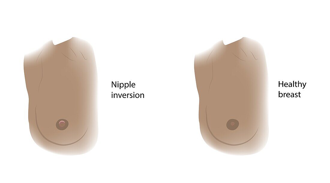 Healthy breast and nipple inversion, illustration