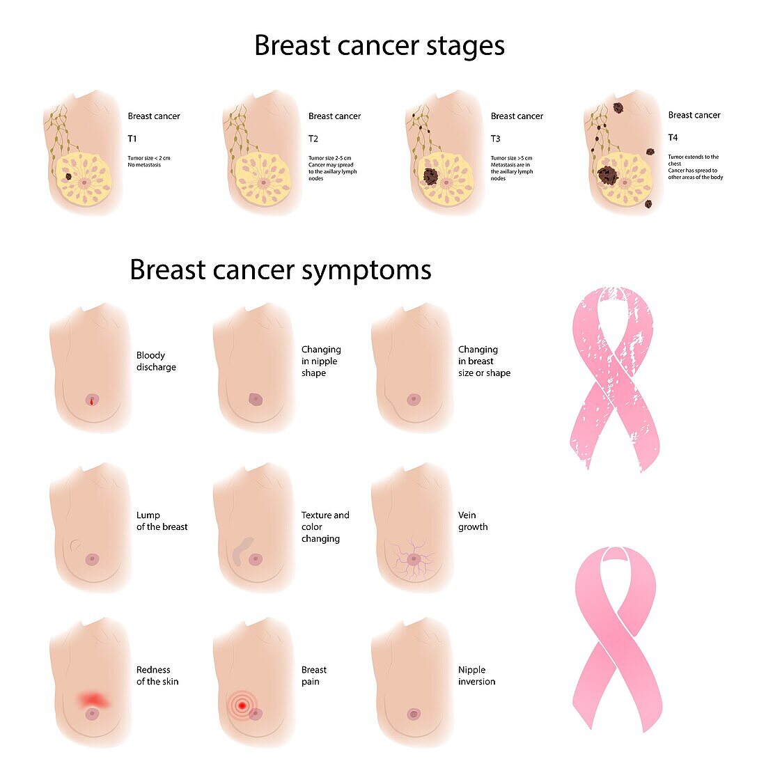 Female breast cancer symptoms and stages, illustration
