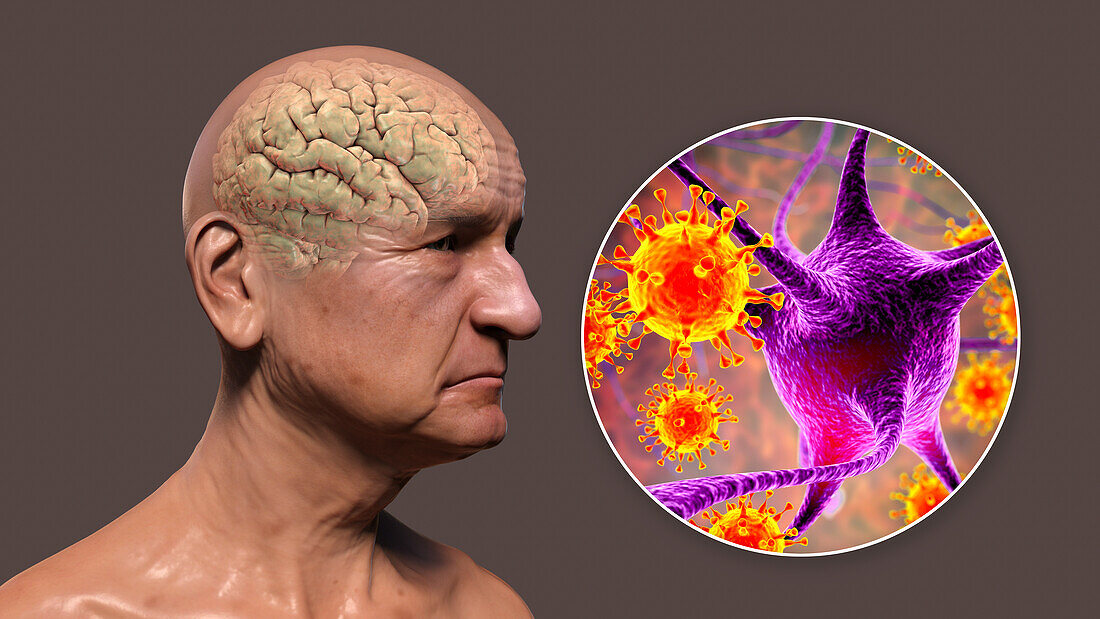 Infectious aetiology of dementia, illustration