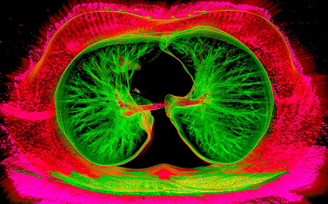 Heart and lungs, CT scan