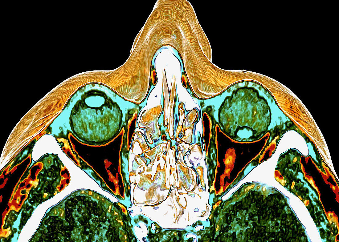 Traumatic detachment of the lens of the eye, CT scan