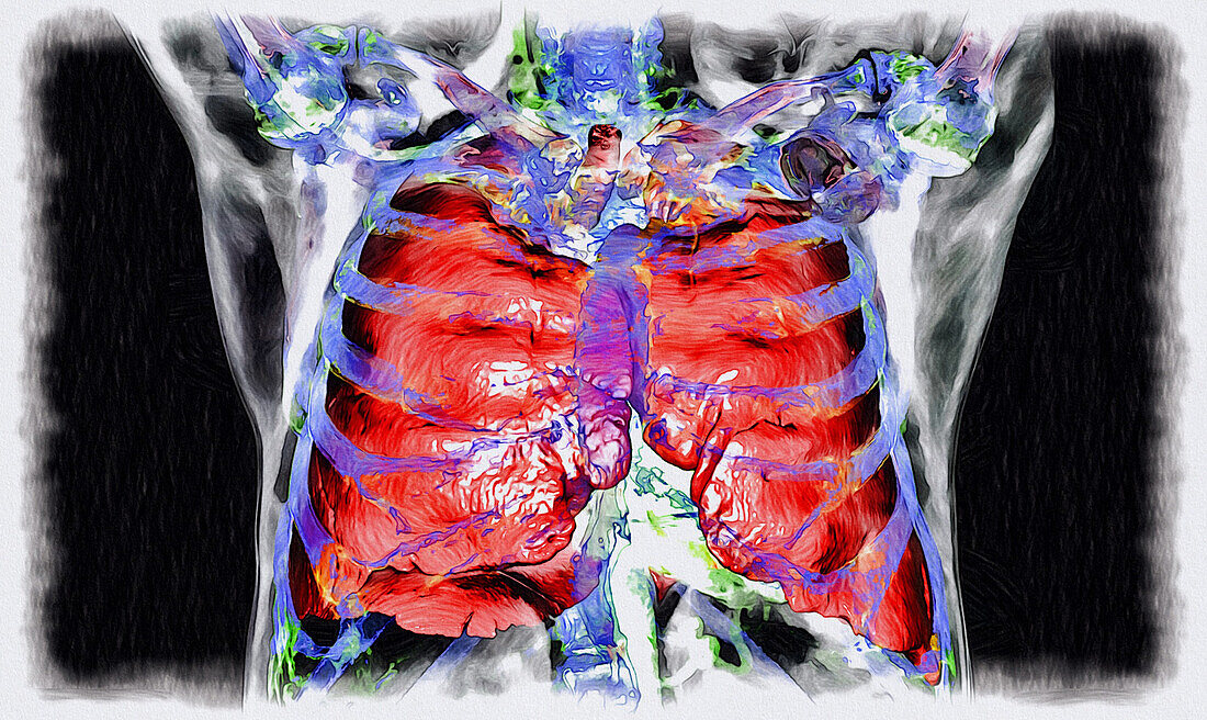 Lungs and ribs, CT scan