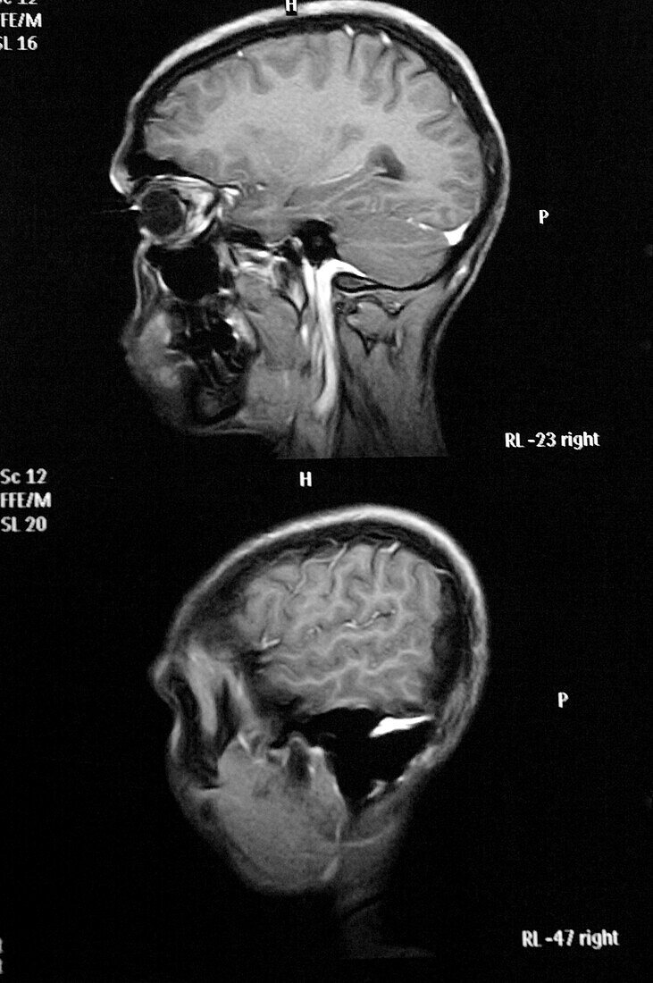 Myeloma, MRI scan