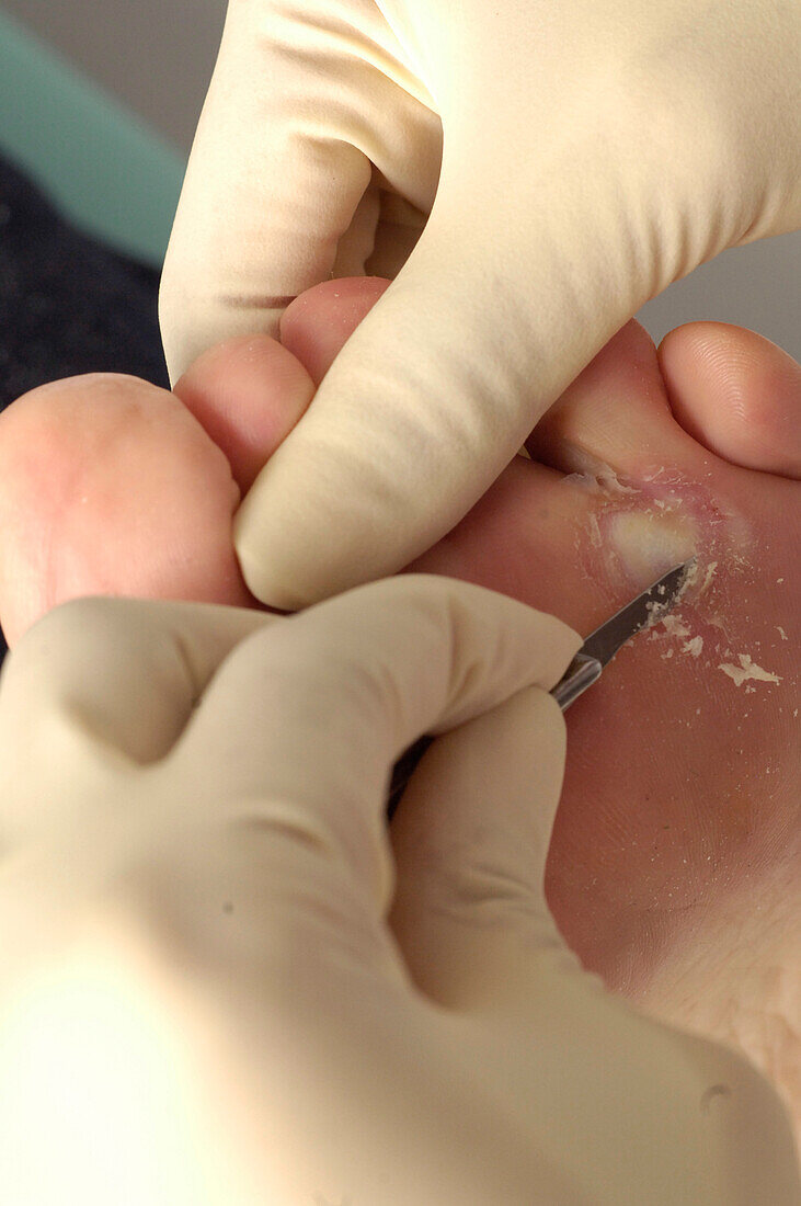 Chiropodist removing hardened skin