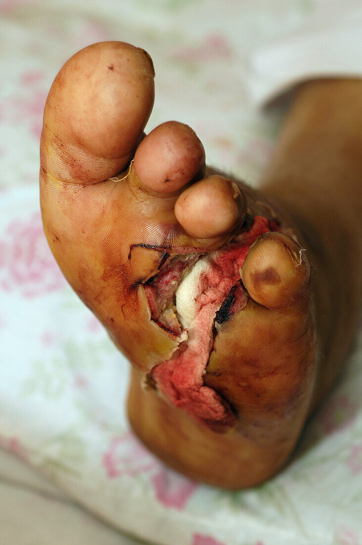 Diabetic septic foot
