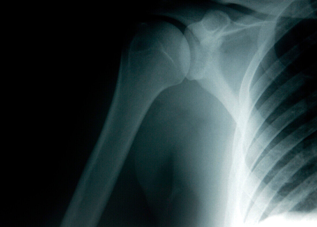 Shoulder, X-ray